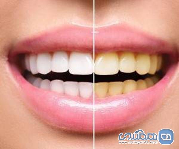 جرم گیری دندان چند بار در سال باید انجام گردد؟